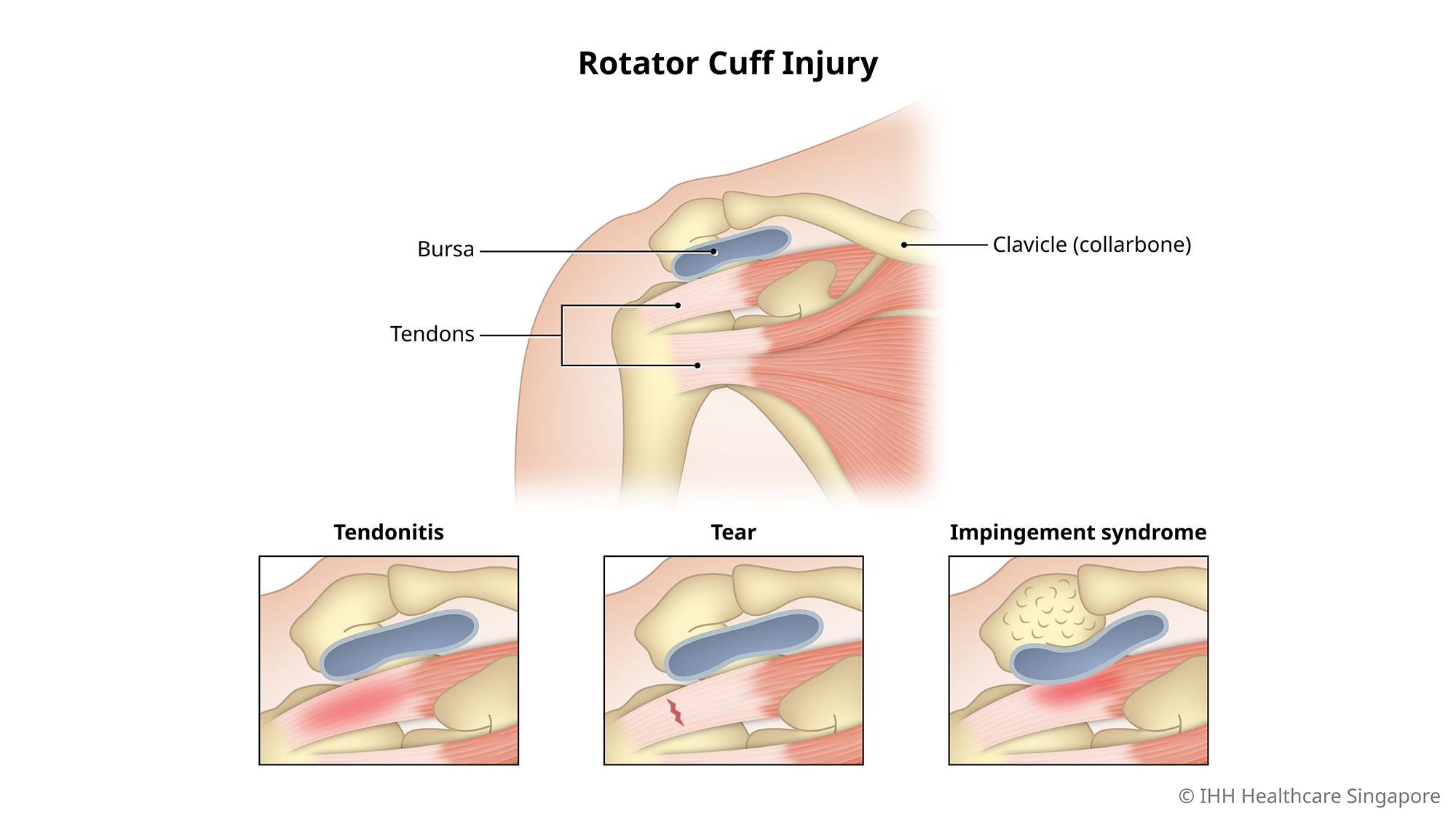 Apa Itu Rotator. Symptoms & Causes